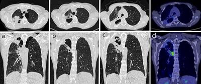 Case Report: Chronic Pulmonary Aspergillosis—An Unusual Long-Term Complication of Lung Cancer Treatment